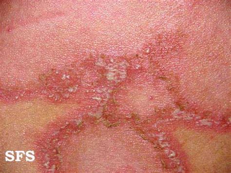 Impetigo herpetiformis - wikidoc