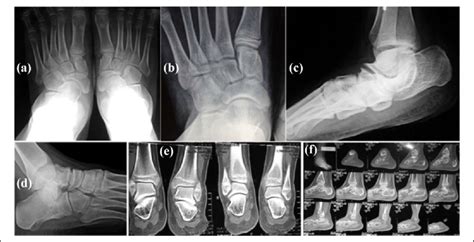 (a) to (f) Radiological findings in some of the studied cases. (a ...