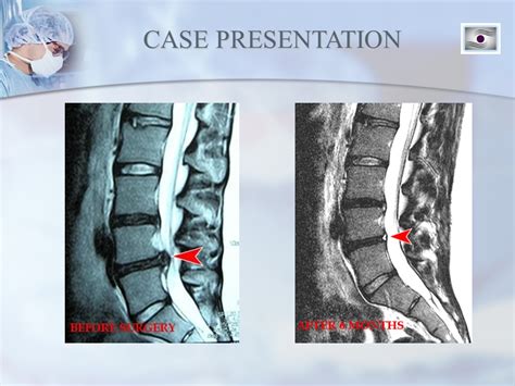 Dr. Luis Lombardi-L4/L5 Herniated Disc - Doctor Luis Lombardi