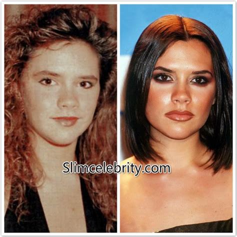 Victoria Beckham Plastic Surgery Nose Job, Botox Injections Before and ...