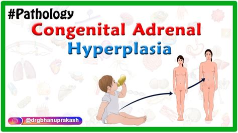 Congenital adrenal hyperplasia : Etiology ,Pathophysiology ,Clinical features ,Diagnosis ...