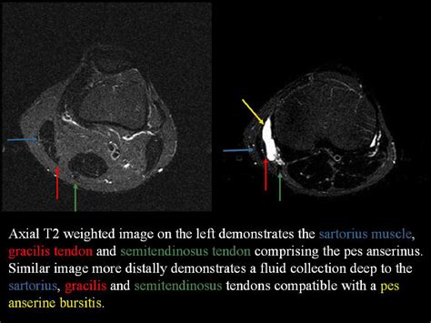 Figure 1 from Bursae of the Knee: A Clinical and Radiological Review ...