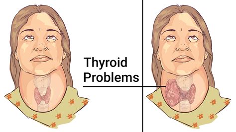 5 Easy Ways to Relieve Thyroid Problems Naturally | Power of Positivity