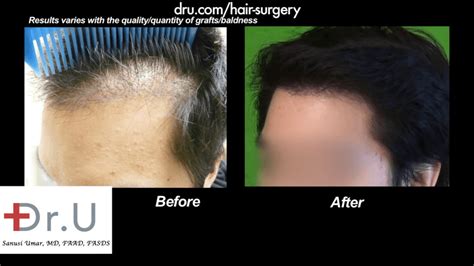 Dr Umar Hair Transplant Reviews Los Angeles | HairSite.com