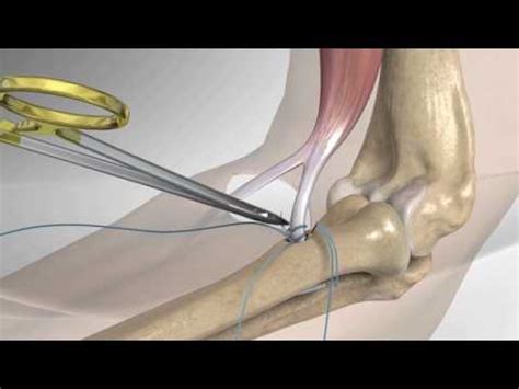 Distal Biceps Repair with Arthrex® Tension Slide - YouTube