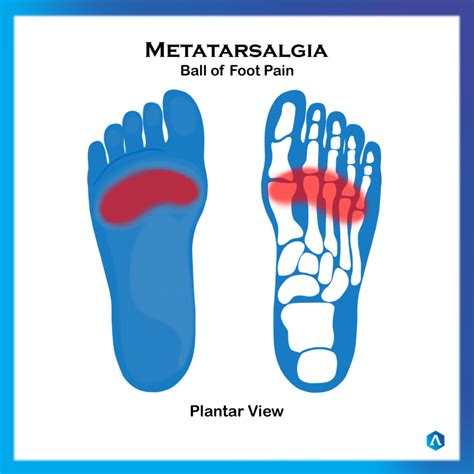 Metatarsalgia (ball of foot pain) | Dr. Abbie Clinics