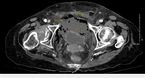 Figure 1 from Acute Perforated Appendicitis Complicated by Necrotizing Fasciitis and Bladder ...