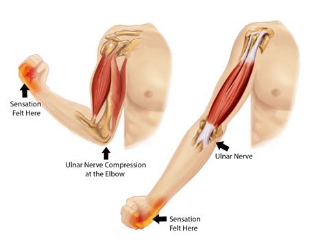 Cubital Tunnel Syndrome : Causes,Symptoms,Diagnosis & Treatment » How ...