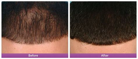 Stimulating hair growth with PRP - LAZEO