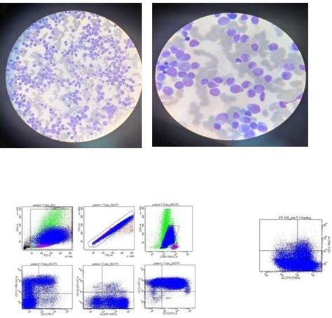 Acute Monoblastic leukemia (AML M5) with flow cytometry showed... | Download Scientific Diagram