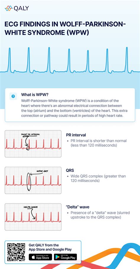 What Wolff-Parkinson-White Syndrome (WPW) Looks Like on Your Watch ECG | Qaly