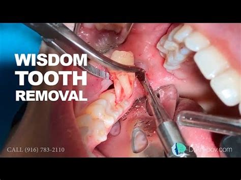 Wisdom tooth removal in 5 MIN or less - YouTube