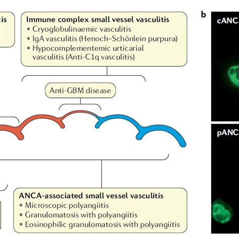 (PDF) ANCA-associated vasculitis