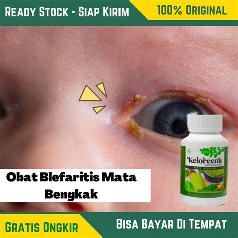 Jual Obat Blefaritis Mata Bengkak , Kelopak Mata Terasa Gatal , Mata ...