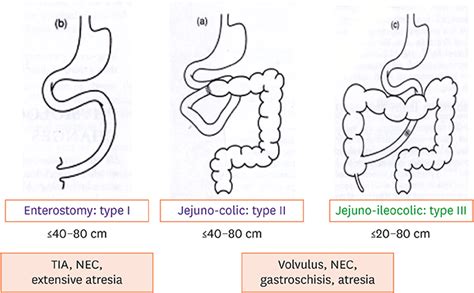 Short Bowel Syndrome as the Leading Cause of Intestinal Failure in ...