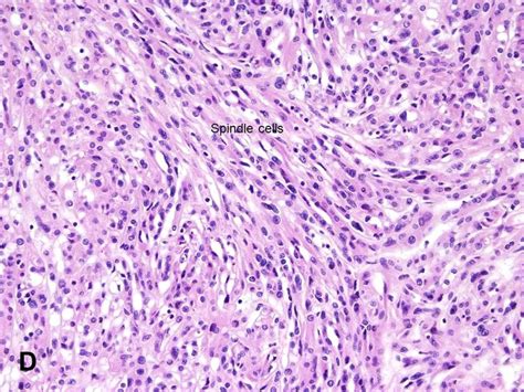 American Urological Association - Mucinous Tubular and Spindle Cell ...