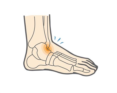 Anterior Ankle Impingement Brace