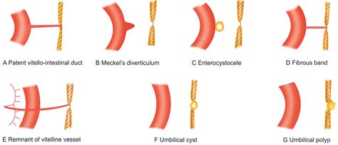 3: Abnormalities of Omphalomesenteric duct | Download Scientific Diagram