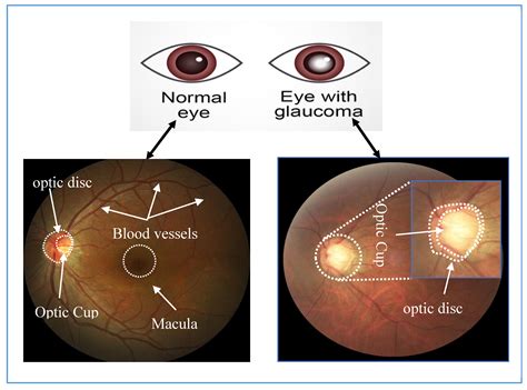 Applied Sciences | Free Full-Text | Deep Learning for Optic Disc Segmentation and Glaucoma ...