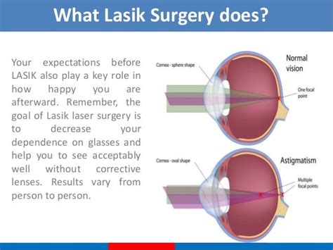 Lasik surgery in delhi