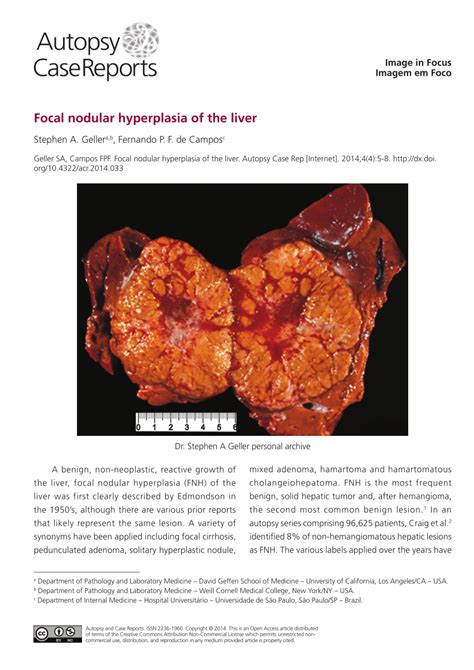 (PDF) Focal nodular hyperplasia of the liver