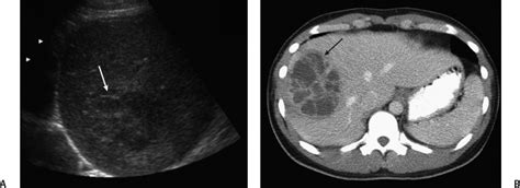 5 Pyogenic Liver Abscess | Radiology Key