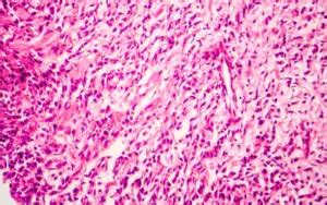 10 Telltale Symptoms of Signet Ring Cell Carcinoma (SRCC): What You Need to Know