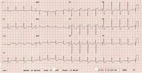 Brugada Syndrome Ekg Findings - Captions Hunter