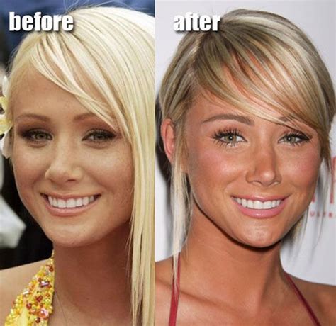 Celebrity Plastic Surgery Before & After (56 pics) | Celebrity surgery, Celebrity plastic ...