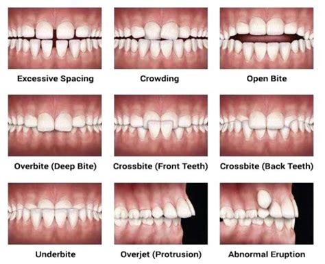 What is Overbite, Underbite, Openbite, Crossbite in Orthodontics - Headgear Braces