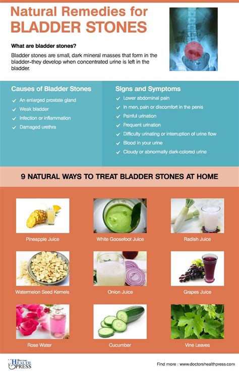 9 Natural Remedies for Bladder Stones | Natural remedies, Natural sleep remedies, Natural cold ...