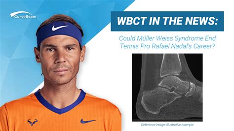 Tennis Player Rafael Nadal Diagnosed with Müller Weiss Syndrome ...