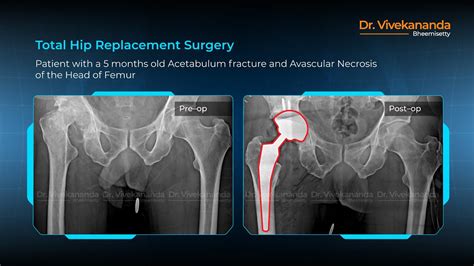 Total Hip Replacement Surgery - Before & After X-Rays - YouTube