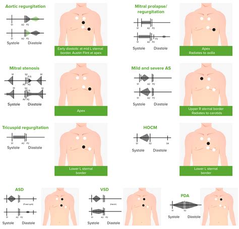 Tricuspid Regurgitation | Concise Medical Knowledge