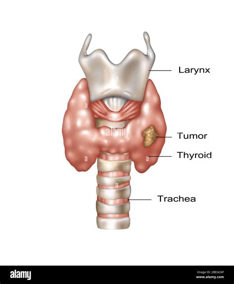 Illustration showing the location of the larynx, thyroid gland, and ...