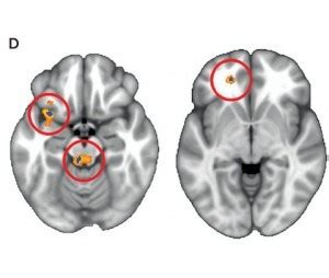 Functional Brain Imaging in Depression - Gateway Psychiatric