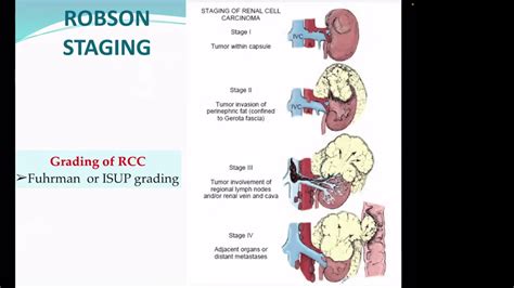 Renal cell carcinoma ( RCC part 3; TNM staging & Management) - YouTube