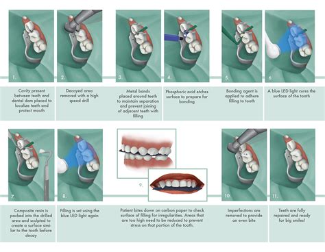 Composite Cavity Filling :: Behance