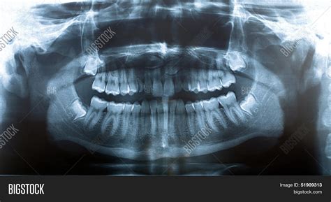 Picture X-ray Jaw Image & Photo (Free Trial) | Bigstock