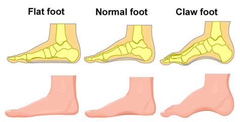 Flat feet (Pes Planus) - Symptoms, Causes and related Sports Injuries