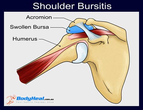 Shoulder Bursitis - MYO Sports