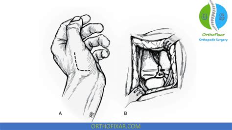 Bennett Fracture Overview | OrthoFixar 2025