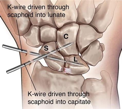 Arthroscopic Anatomy Of The Wrist With Scapholunate Ligament Injury ...