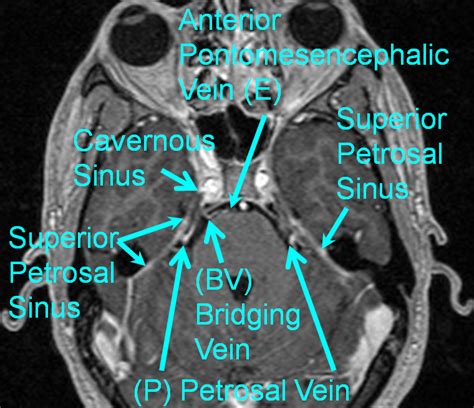 Bridging Vein (anterior brainstem group) | neuroangio.org