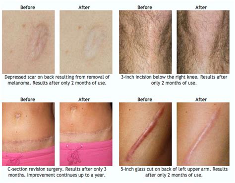 Scar Treatment - How to heal scars. - Precise Medical Supplies