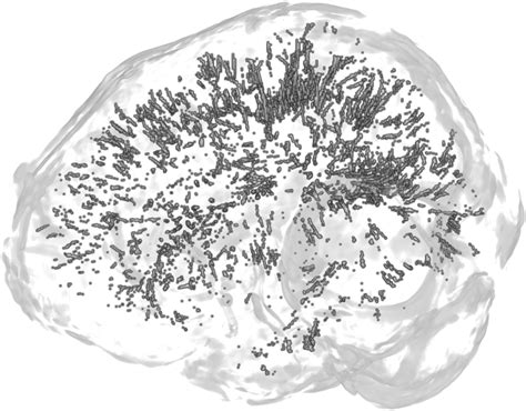 Structural MRI in Migraine: A Review of Migraine Vascular and Structural Changes in Brain ...