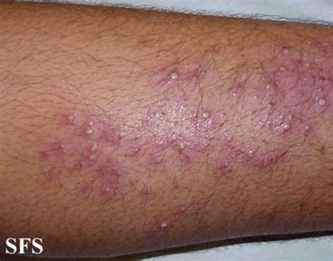 List of Itchy Rashes | hubpages