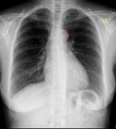 Aortic Knob On Chest X Ray