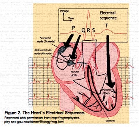 Synchronized vs. Unsynchronized Cardioversion - Perfusion.com