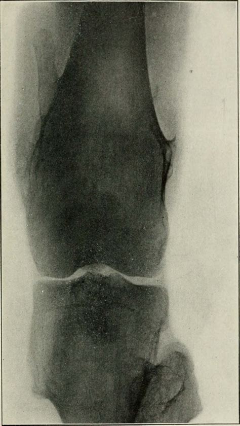 Tuberous sclerosis treatment | General center | SteadyHealth.com